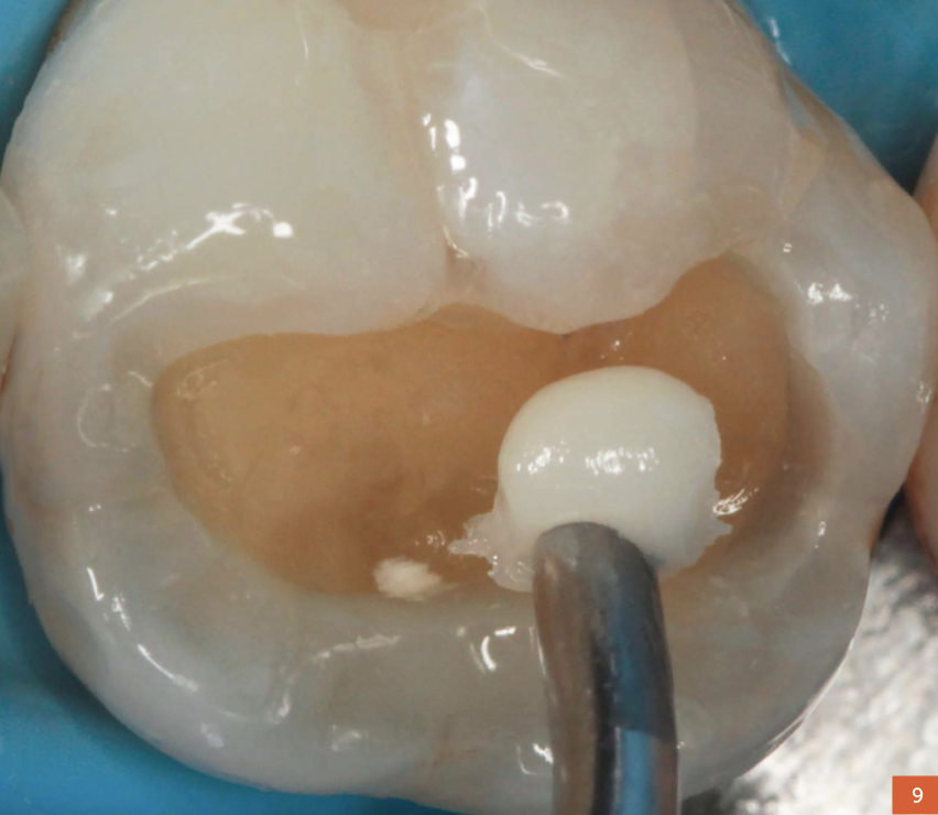 Protocolo De Restauración Para Resina Compuesta En Dientes Posteriores