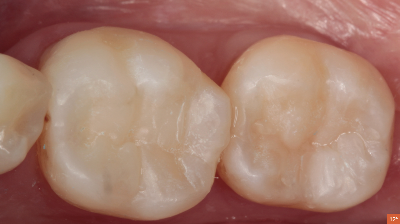 Protocolo De Restauración Para Resina Compuesta En Dientes Posteriores