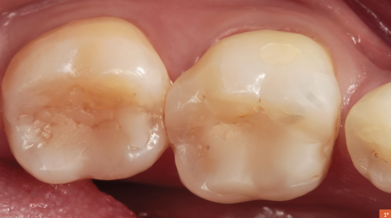 Protocolo De Restauración Para Resina Compuesta En Dientes Posteriores