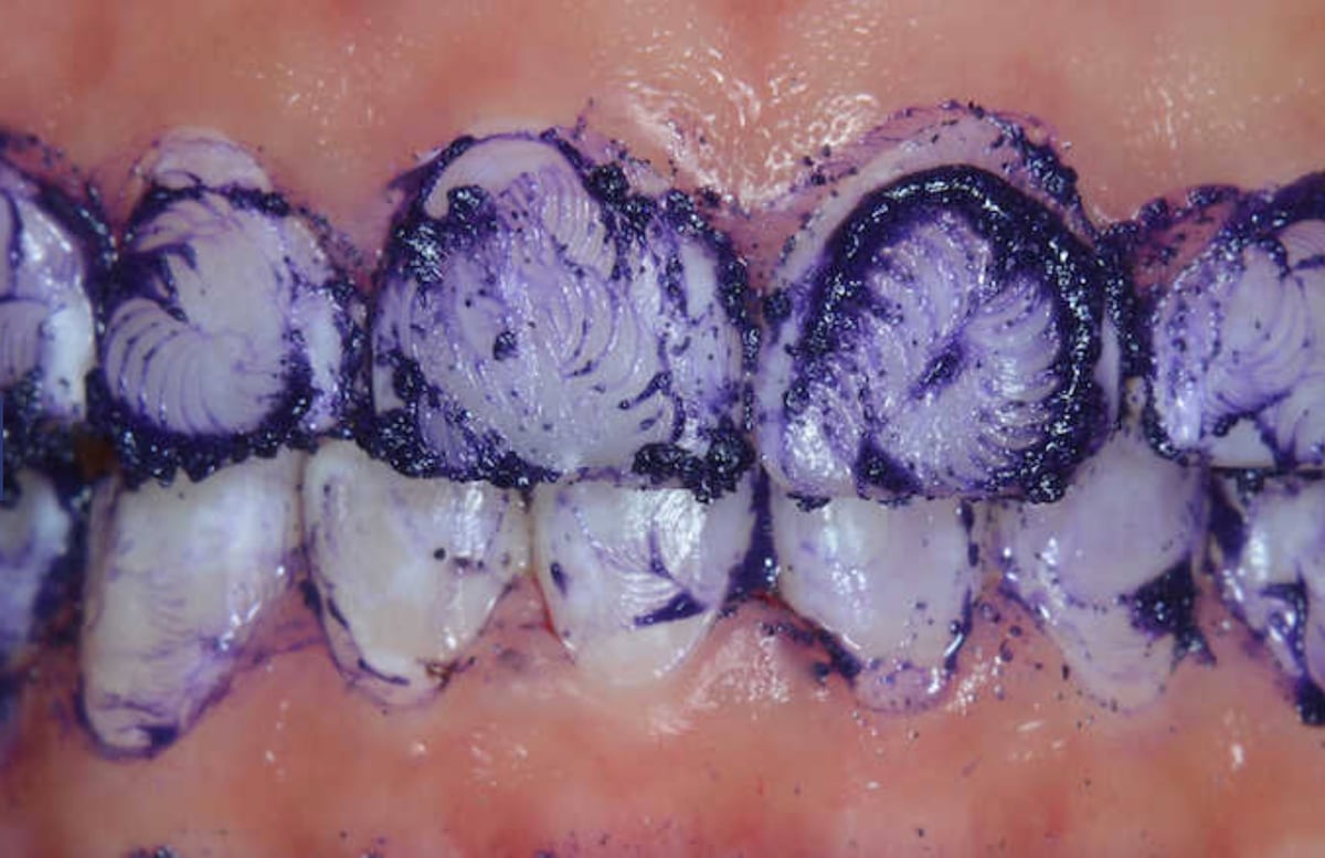 La Microabrasión en Odontología Estética