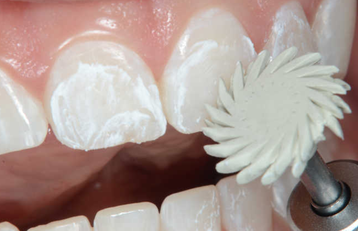 La Microabrasión en Odontología Estética