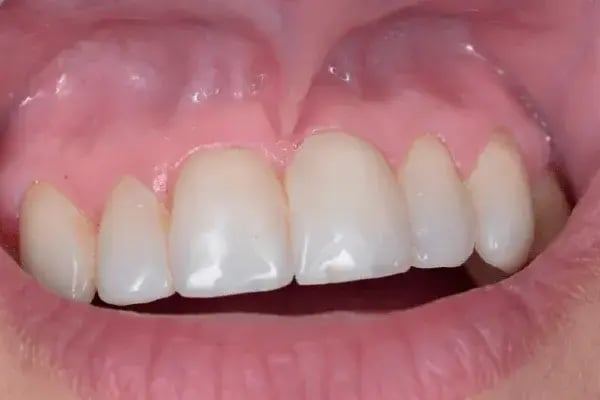 Frenectomia – antes