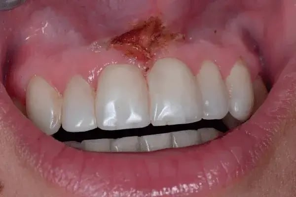 Frenectomia – desoues