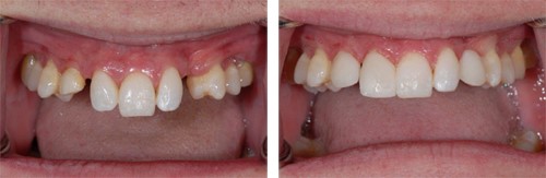 1 alt partial denture