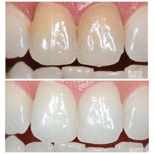opalescence-endo-before-and-after-300x300