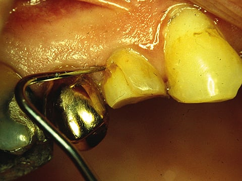 Leakage premolar_©Prof.Tjaderhane