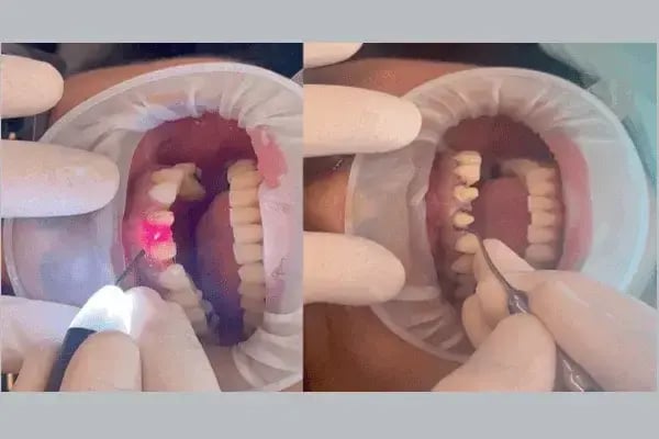 Surcado gingival