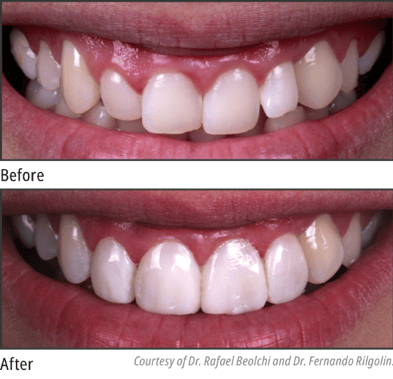 Uveneer Extra Before and After