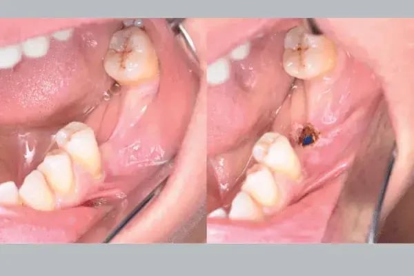 abertura de implantes